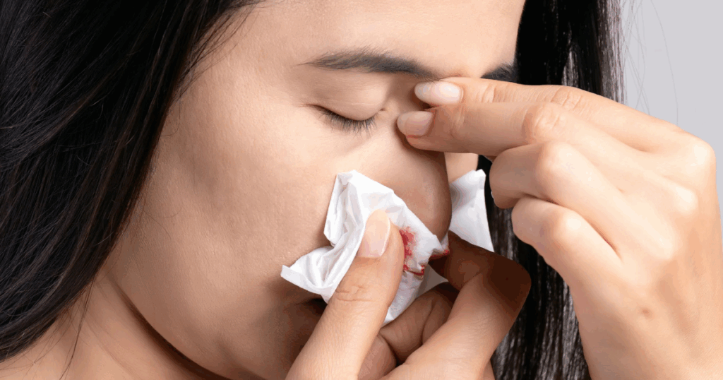 Woman with bloody nose, holding tissue to stop bleeding. Stress and nosebleeds concept. Sinus problem, nasal irritation.